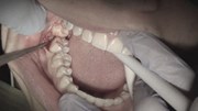 Nhổ răng khôn có thể gây biến chứng dẫn đến tử vong