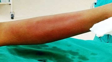 Bé trai suýt mất chân vì để “thầy lang vườn” chích lễ