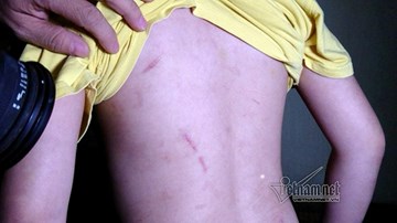 Bé trai bị bố và mẹ kế đánh rạn sọ não xin tha cho bố