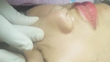 Cô gái mù mắt vì tiêm chất làm đầy mũi: Không thể xử lý cơ sở sai phạm?