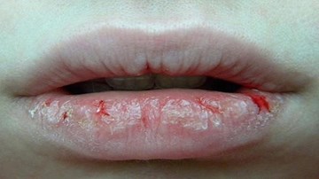 Liếm môi - thói quen có hại khi trời hanh khô