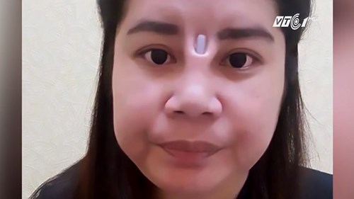Rợn người nâng sống mũi thành lỗ mũi
