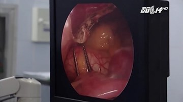 Cận cảnh ca phẫu thuật tim bằng kỹ thuật 3D đầu tiên ở Việt Nam