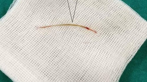 Cứu sống bệnh nhân 72 tuổi bị xương cá đâm thủng ruột