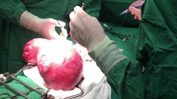 Cô gái mang khối u 4kg trong bụng mà không biết