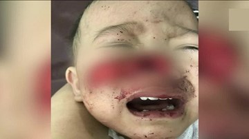 Cha mẹ lơ là, 2 trẻ bị chó nhà cắn nghiêm trọng