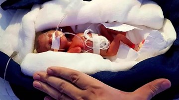 Sức sống của bé gái tí hon, chào đời chỉ nặng bằng thanh chocolate