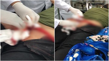 Nam thanh niên rách mông vì ngồi xổm khi đi vệ sinh