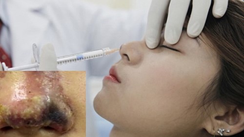 Dùng chỉ vĩnh viễn nâng mũi làm đẹp, cô gái hoại tử, suýt thủng mũi