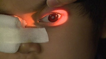 Nguy cơ đục thủy tinh thể suốt đời do lạm dụng thuốc corticoid