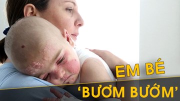 Câu chuyện xót xa của những 'em bé bươm bướm'