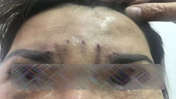 Biến dạng mặt vì treo chân mày bằng chỉ giá rẻ