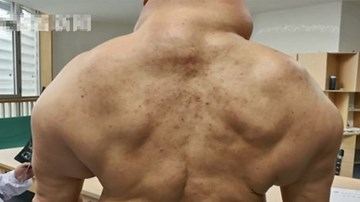 Cơ thể biến đổi dị dạng do uống rượu hàng ngày
