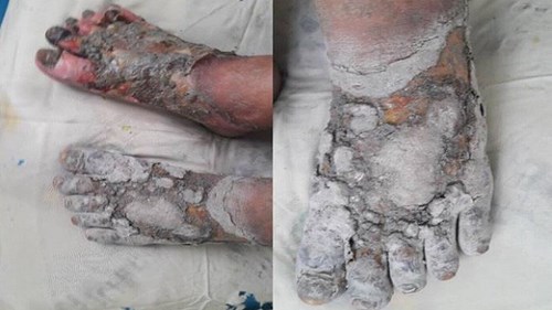 Chữa bệnh bằng thuốc nam không rõ nguồn gốc, cẩn thận cụt chi