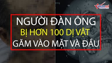 Người đàn ông bị hơn 100 dị vật găm vào mặt và đầu