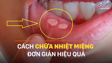 Cách chữa nhiệt miệng đơn giản, hiệu quả