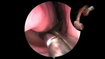 Khó tin: Gắp con vắt sống trong lỗ mũi hơn 1 tháng