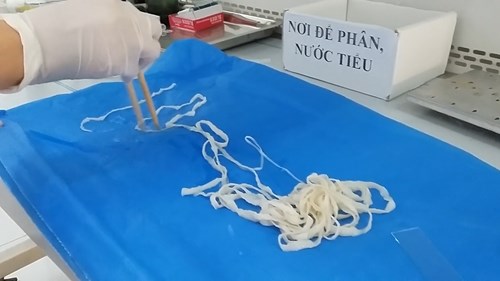 Rùng mình con sán dây dài 5,2m trong cơ thể cô gái