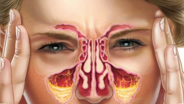 Tự trị viêm xoang ở nhà hiệu quả với 5 cách đơn giản