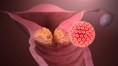 Hiểu về HPV - virus lây qua đường 'yêu' phổ biến nhất hiện nay
