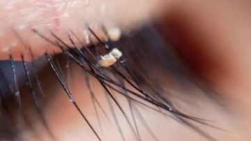 Nối mi: Xu hướng làm đẹp với những mối nguy hại khó lường