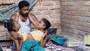 Chuyện tình cảm động của chàng trai với 2 chị em song sinh dính liền thân