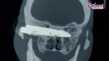 Lấy lưỡi dao dài 10cm nằm trong đầu người đàn ông suốt 26 năm