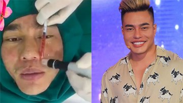 Lê Dương Bảo Lâm đau đớn thẩm mỹ nhiều lần, con gái không dám gần