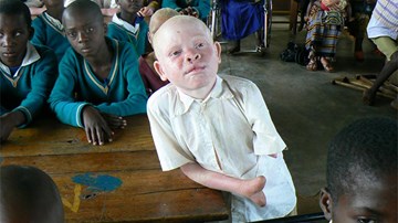 Nạn săn bắt người bạch tạng, lấy tay, lấy xương để làm giàu ở châu Phi