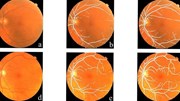 Phát hiện sớm bệnh Parkinson nhờ kiểm tra mắt bằng trí tuệ nhân tạo