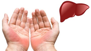 Những bất thường trên bàn tay cảnh báo sức khỏe đang gặp vấn đề