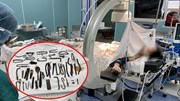 Bác sĩ gắp cả ‘vựa ve chai’ trong bụng bệnh nhân ở Bình Dương