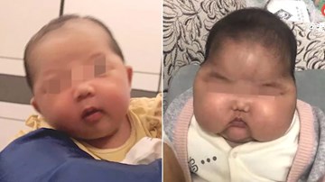 Bôi kem dưỡng có độc, bé gái TQ má mọc lông, trán nhô ra, cứng như đá