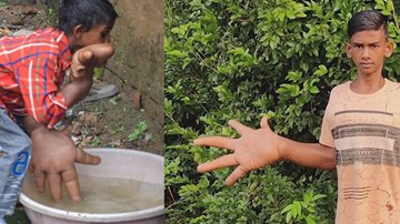 Cuộc sống đầy cảm hứng của chàng trai có đôi bàn tay khổng lồ, kỳ quặc