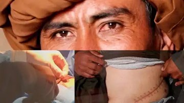Đất nước chìm trong bóng tối, số người đi bán thận ở Afghanistan tăng vọt